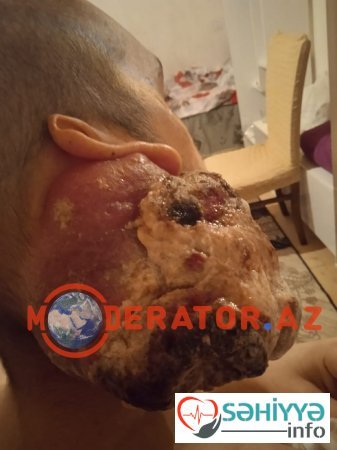 "Sabunçu" xəstəxanasında əməliyyat olunan xəstə: "Həkim məndən heç bir analiz götürmədən əməliyyat etdi" "Sabunçu" xəstəxanasında əməliyyat olunan xəstə: "Həkim məndən heç bir analiz götürmədən əməliyyat etdi"