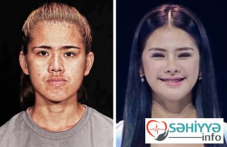 Plastik əməliyyatın dəyişdiyi 10 qadın Plastik əməliyyatın dəyişdiyi 10 qadın