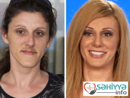 Plastik əməliyyatın dəyişdiyi 10 qadın Plastik əməliyyatın dəyişdiyi 10 qadın