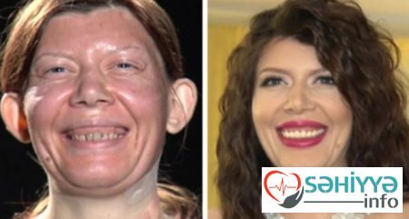 Plastik əməliyyatın dəyişdiyi 10 qadın Plastik əməliyyatın dəyişdiyi 10 qadın