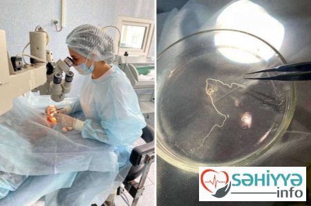 Qadının gözündən diri qurd çıxarıldı