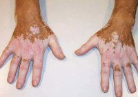 İmmun xəstəliklərin müalicəsi haqqında. Həkim məsləhəti