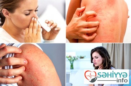 Allergik xəstəliklər haqqında. Həkim məsləhəti