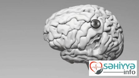 Çin insan beyninə implant yerləşdirdi: Artıq düşüncə ilə videooyun oynayır