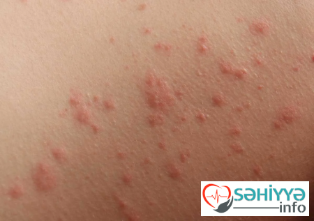 Yay allergiyası barədə. Həkim məsləhəti