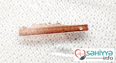 BÖYRƏK DAŞINDAN MAQNİTLƏ XİLAS OLMA