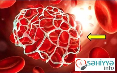 Bir anın içində ölüm səbəbi - Bədəndə tromb olduğunu göstərən 6 əlamət