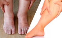 Ayaqlar niyə şişir ? Həkim məsləhəti