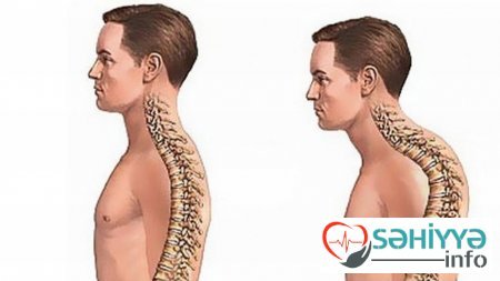 Biraz da kifoz haqqında. Tanınnmış həkim terapevt danışır.