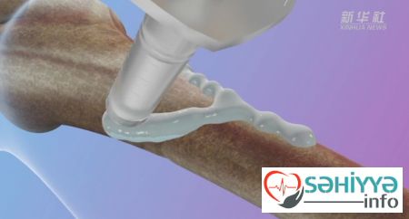 Çin alimləri sınıqları 3 dəqiqəyə sağaldan “sümük yapışdırıcısı” hazırladılar