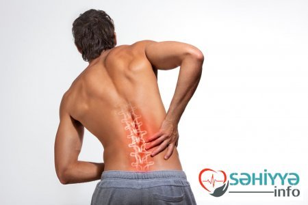 Bel ağrıları , müayinə və müalicəsi barədə. Həkim məsləhəti