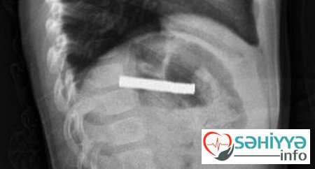 3 yaşlı uşağın boğazından 19 maqnit çıxarıldı