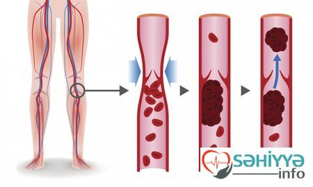 Varikozun qorxulu olması barədə. Həkim məsləhəti