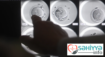 Süni mayalanma qadın sağlamlığını məhv edir? - Rusiyalı həkimdən AÇIQLAMA