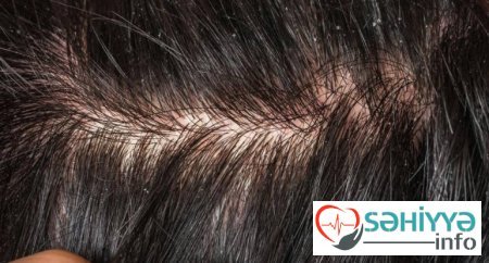 Çox addam ciddiyə almır - Ağır xəstəliklərin əlaməti ola bilər