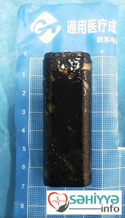 35 il mədəsində udduğu alışqanla gəzdi