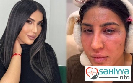 Reklam etdiyi pilinq Ləmanın üzünü yandırdı