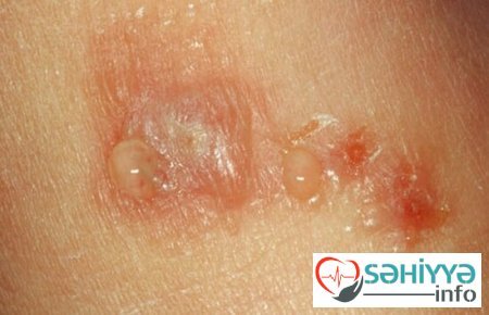 Dəri xəstəlikləri haqqında. Həkim məsləhəti