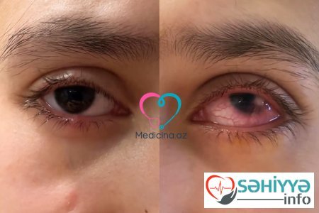 Çox şirniyyat yeyən uşağın gözü dəhşətli hala düşdü - VİDEO