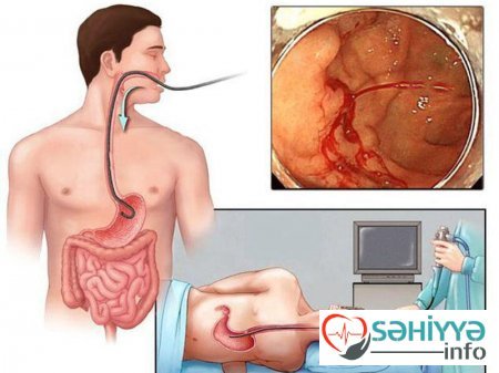 Həkim qastrit diaqnozu ilə bağlı məşhur mifi təkzib etdi