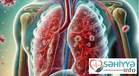 Vərəm xəstəliyinə yoluxma halları artıb