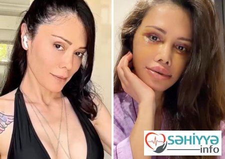 Əməliyyatla üzünü dəyişdirdi, tanınmaz hala düşdü