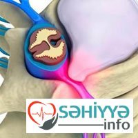 Onurğa deformasiyaları haqqında. Həkim məsləhəti