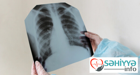 Dünyada təxminən iki milyard insan gizli vərəmə yoluxub