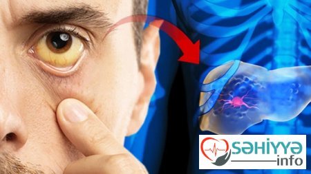 Qaraciyərin görünməz qatili: Çox az bilinən, sürətlə məhvə aparan təhlükə