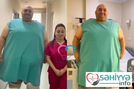 Azərbaycanda 330 kq çəkili kişi əməliyyat olundu