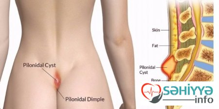 Tük dönməsi (Pilonidal sinus) haqqənda. Həkim məsləhəti