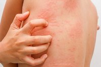 Allergiya haqqında. Səbəbləri, simptomları. Həkim məsləhəti