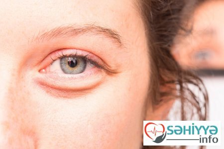 Astiqmatizm baş ağrısına səbəb olur
