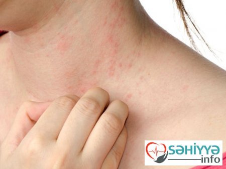 Allergiyanın orqanizmdə fəsadları barədə. Həkim məsləhəti